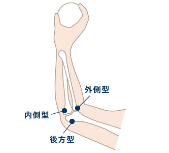 野球肘の分類